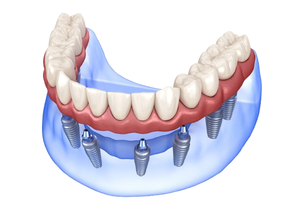 Denture Image