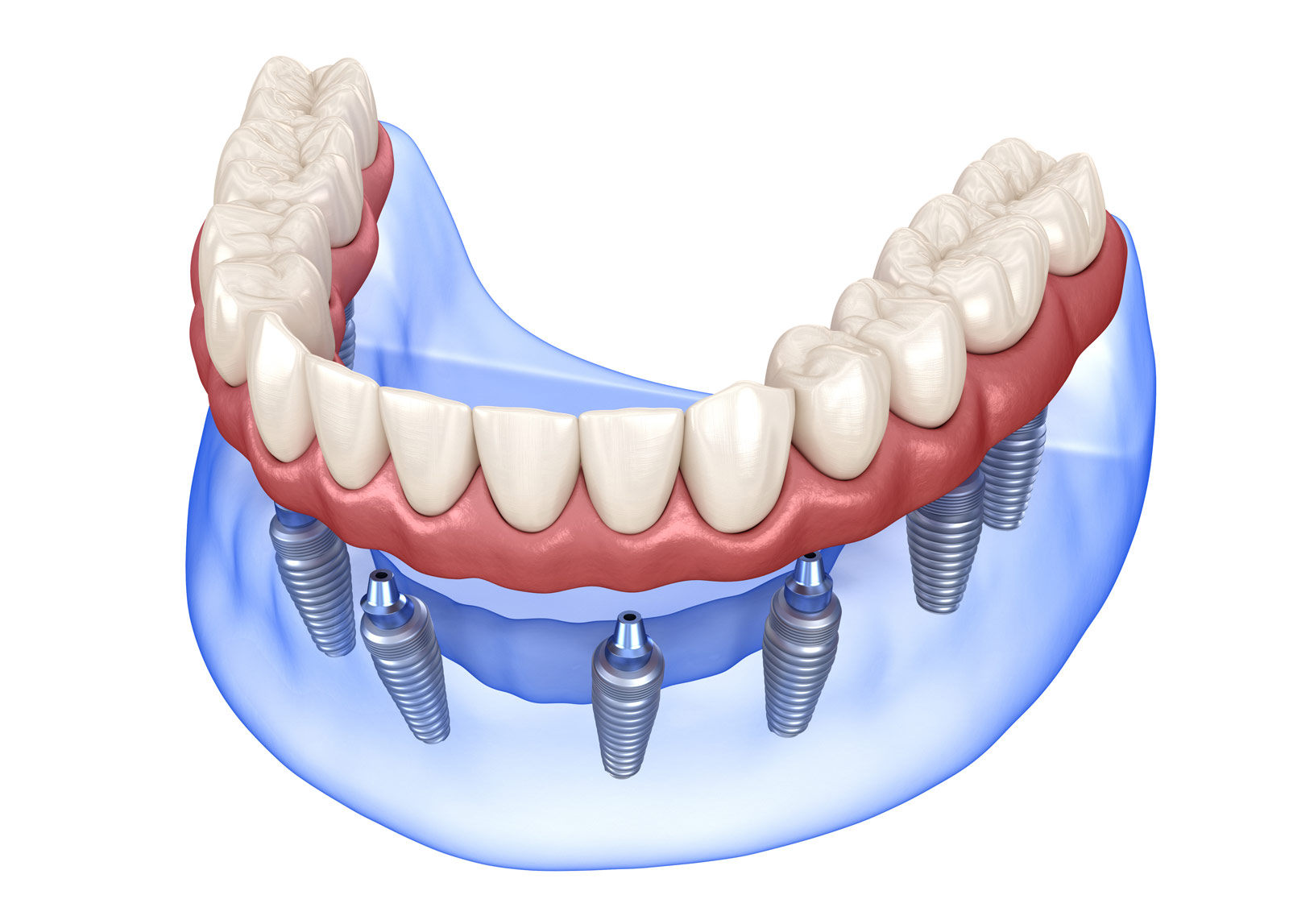 4 Implant Retained Overdentures