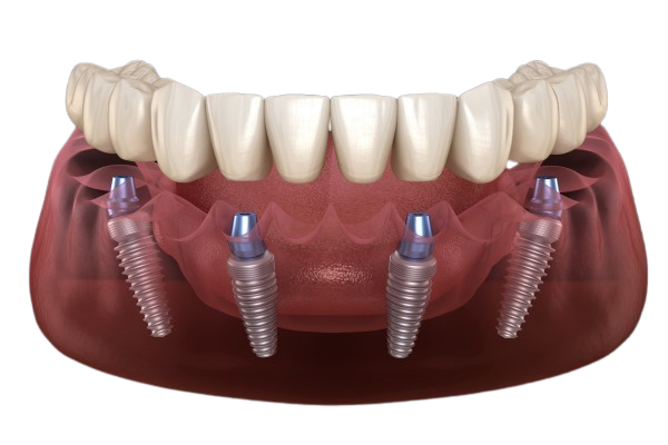All-on-X Full Arch