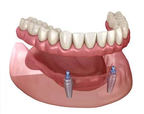 2 Implant Lower Retained Overdentures